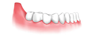 Implant-Supported Removable Dentures Implant-Supported Removable Dentures