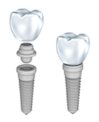 Implants Implants