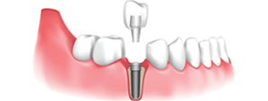 Implant-Supported Fixed Dentures Implant-Supported Fixed Dentures